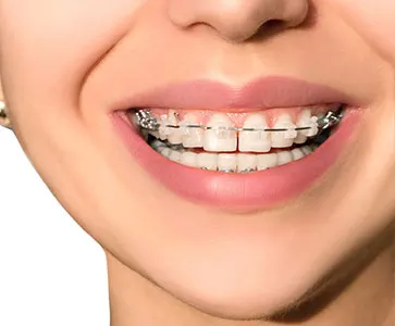 aparelho autoligante